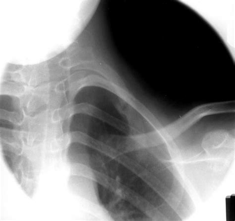 Two cases of isolated first rib fracture | Emergency Medicine Journal