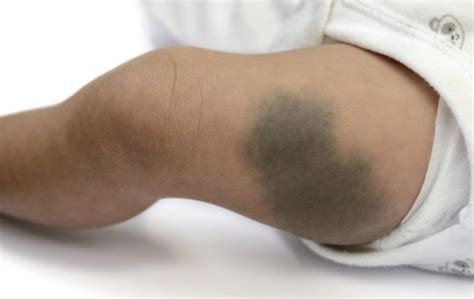 Mongolian Birthmark or Spot: Causes, Signs & Removal - Skincarederm