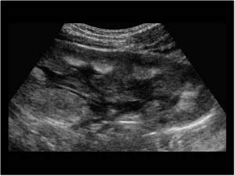 Pediatrics | 9.2 Pediatric urinary tract : Case 9.2.9 Neonatal kidney and nephrocalcinosis ...