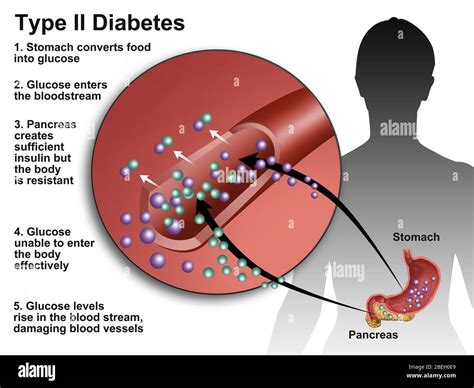 Type 2 diabetes diagram hi-res stock photography and images - Alamy