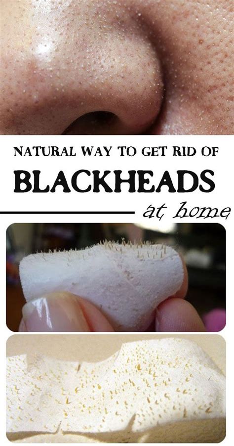 How to get rid of Blackheads naturally - Healthy Lifestyle