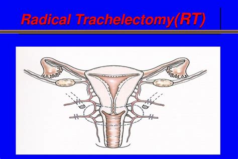 PPT - Fertility Sparing in Gynecological Cancers PowerPoint Presentation - ID:524004