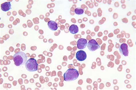 Microscopic Views of Leukemia and Lymphoma Blood Cancer