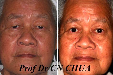 Eyelid Surgery by Prof Dr CN CHUA 蔡鐘能: How the Excess Upper Eyelid ...