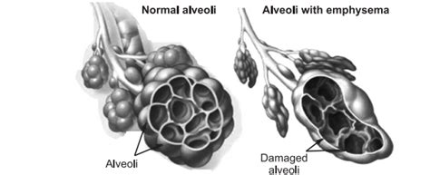 Emphysema Symptoms& Treatment Drugs | Tests and Diagnosis - Pharmacy ...