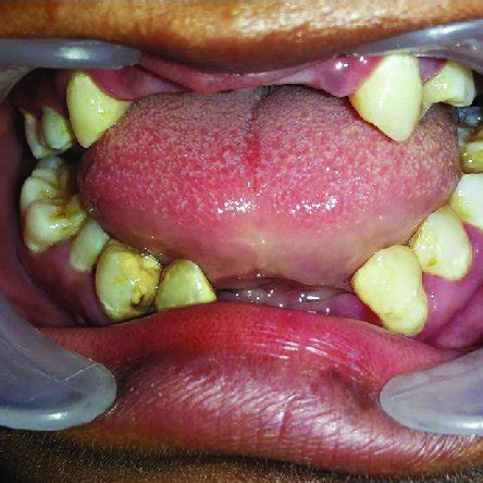 (PDF) Dentin dysplasia type I - A rare entity