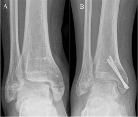 Isolated Medial Malleolus Fractures: Conventional Techniques Versus ...