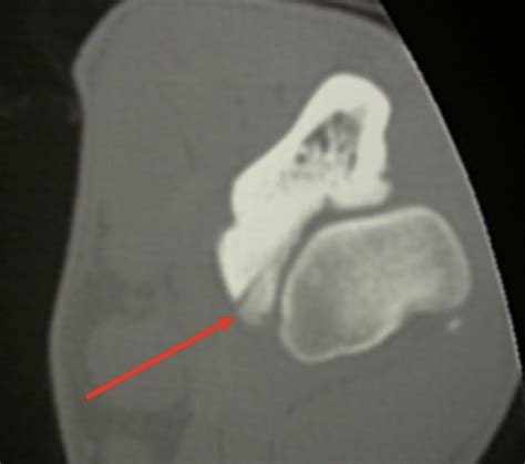 Treatment of Elbow Dysplasia