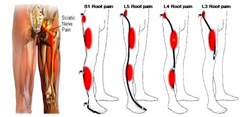 Leg Pain Chart