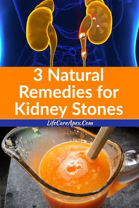 3 Natural Remedies for Kidney Stones #Health Remedy | Natural remedies, Kidney stones remedy ...