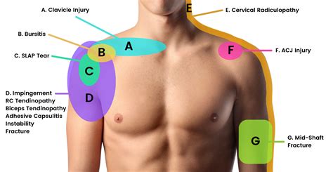 Mastering the Shoulder Exam: Top Chiropractic Tests for Rotator Cuff and Impingement — ChiroUp