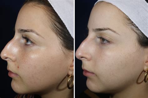 What To Expect When You Laser Away Your Acne Scars | Into The Gloss