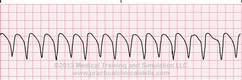 Taquicardia Ventricular Monomórfica | EKG.Academy