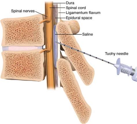 Epidural Catheter Depth Markings