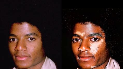 Vitiligo Michael Jackson Before And After