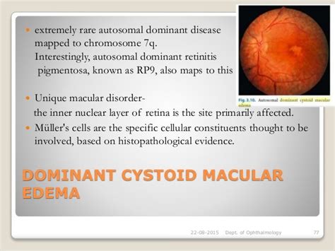 Cystoid macular oedema