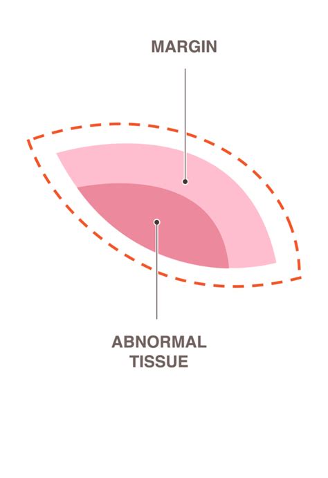 Breast Biopsy: Procedure Types, What to Expect & Results Guide