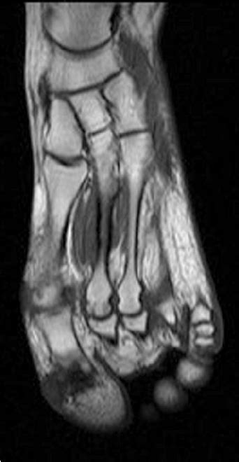 Mri Of Foot Stress Fracture