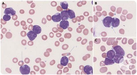 Cuplike nuclear morphology in pediatric B-cell acute lymphoblastic leukemia