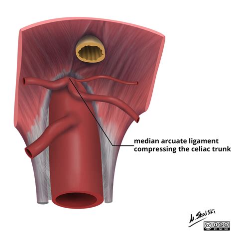 Image | Radiopaedia.org