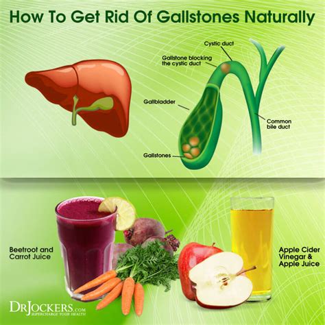 Awesome Info About How To Avoid Getting Gallstones - Commandbid31