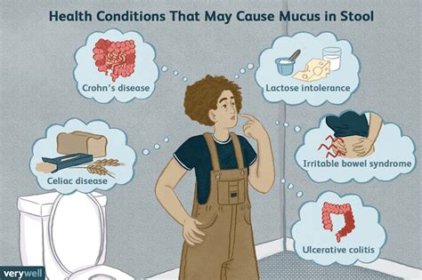 Irritable Bowel Syndrome and Mucus in Your Stool