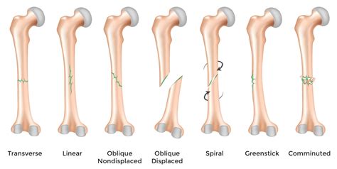 Oblique bone fracture - intseka