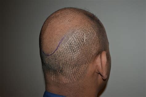 The Best Place to Get a Hair Transplant - DHI International