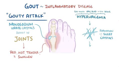 Anti-gout Diet: Foods to Eat, Foods to Avoid, and More | Osmosis