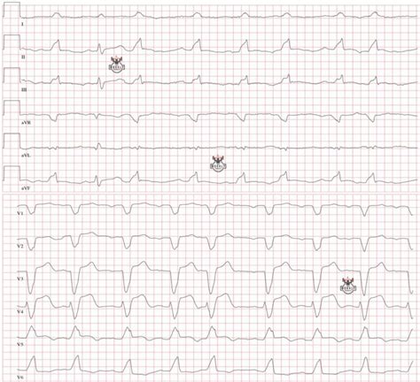 Literature Review: modified Sgarbossa criteria in the diagnosis of ...