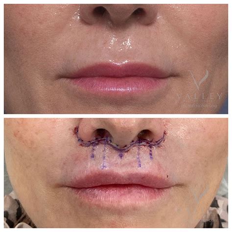 The Lip Lift Procedure with Dr Raymond Goh - PSH