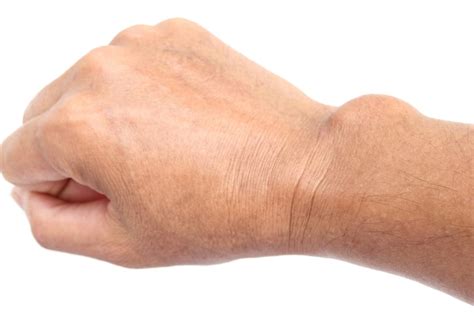 Should You Worry About Ganglion Cysts? - Colorado Center of Orthopaedic ...