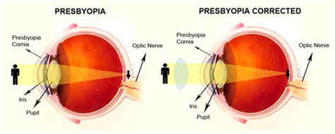 Presbyopia - Optometrists | Masons Eyecare