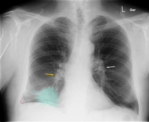 Small Cell Lung Cancer Chest X Ray