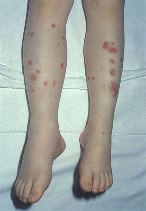 Purpuric and petechial rashes in adults and children: initial ...