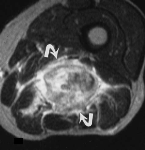 Cross-Sectional Imaging of Peripheral Nerve Sheath Tumors Characteristic Signs on CT, MR Imaging ...