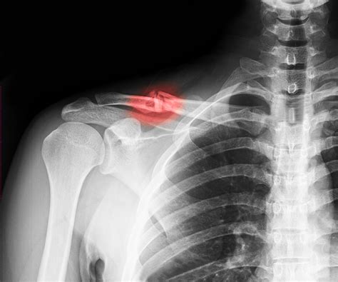 Broken Collarbones | Why Clavicle Fractures are now repaired