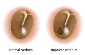 Eardrum Rupture - Otolaryngology Specialists of North Texas