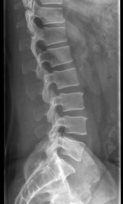 Lateral Lumbar Spine X-Ray Diagram | Quizlet