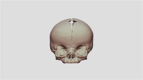 Bilateral Coronal Craniosynostosis - 3D model by nascene [1ec4233 ...