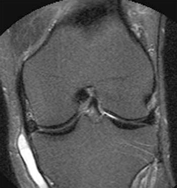 Pes Anserinus Bursitis | Radsource