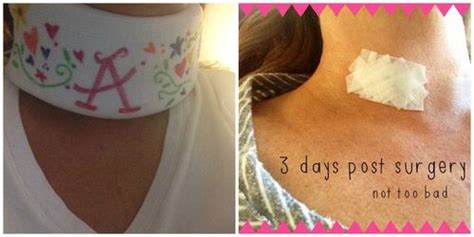 {12 weeks post ACDF Surgery} | Acdf surgery, Surgery, Neck surgery