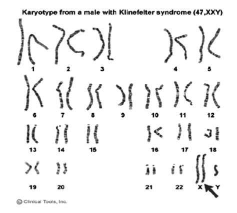 A Karyotype Of Klinefelter Syndrome Explained Karyotypinghub | Images ...