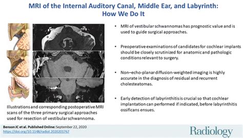 MRI of the Internal Auditory Canal, Labyrinth, and Middle Ear: How We Do It | Radiology