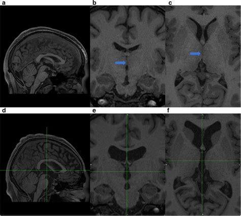 T1-weighted MRI images of the third ventricle showing presence, b and c... | Download Scientific ...