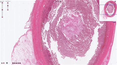 Acute Appendicitis Histology Diagram