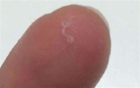 Worms plucked from woman's eye make medical history