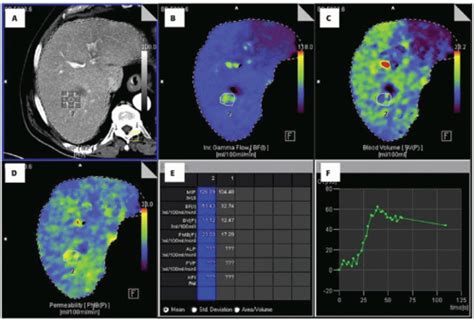 Liver Perfusion Imaging with CT | Radiology Key