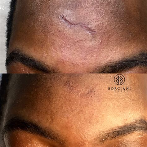 Scar Camouflage, Scar Removal and Scar Treatment - Borciani London