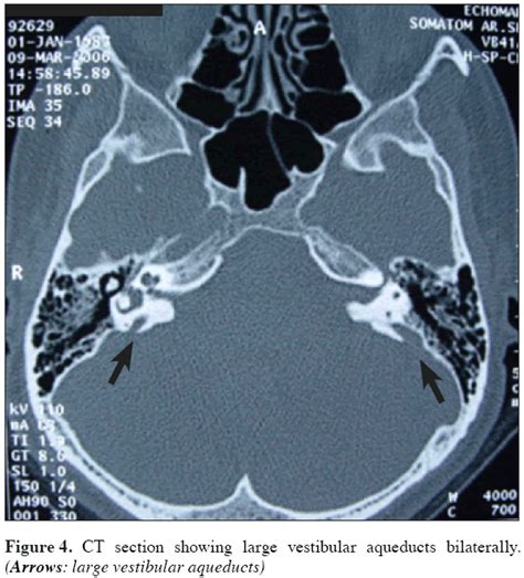 Large vestibular aqueduct syndrome: report of 3 cases